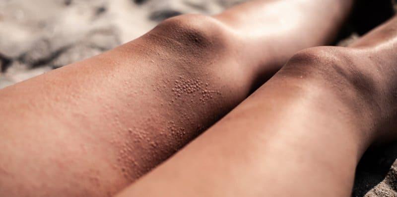 what-is-photosensitivity