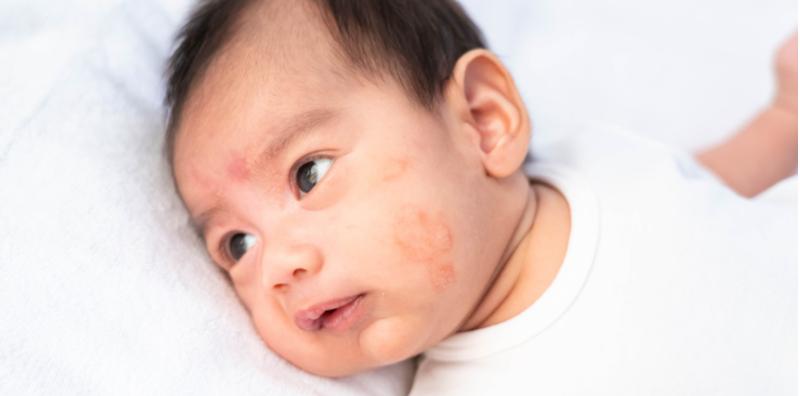what-is-atopic-dermatitis
