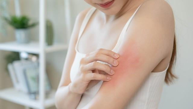 chronic-idiopathic-urticaria