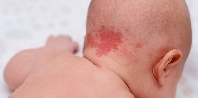 what-to-do-when-baby-has-the-salmon-patch