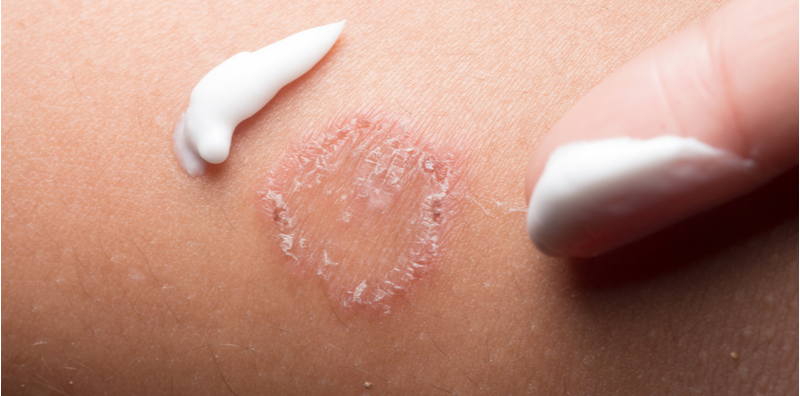 what-is-tinea-corporis