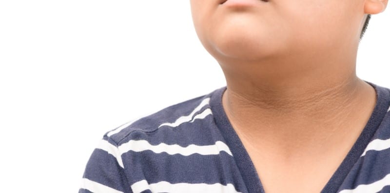 what-is-acanthosis-nigricans